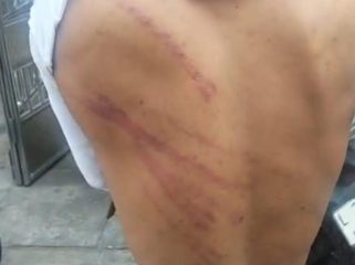 Memar, dugaan korban mengalami kekerasan di Majliz. 